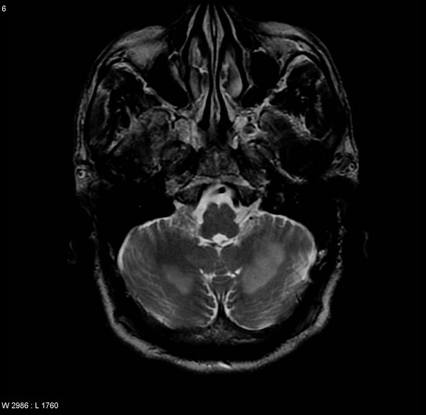 File:Chronic hypertensive encephalopathy (Radiopaedia 4564-6686 Axial T2 1).jpg