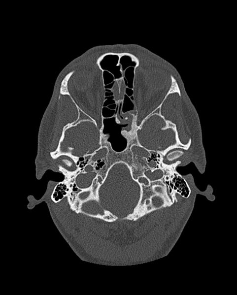 File:Chronic maxillary sinusitis caused by a foreign body (Radiopaedia 58521-65676 Axial bone window 216).jpg
