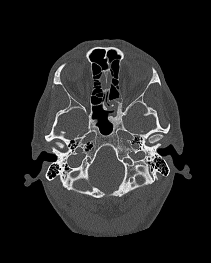 Chronic maxillary sinusitis caused by a foreign body (Radiopaedia 58521-65676 Axial bone window 216).jpg