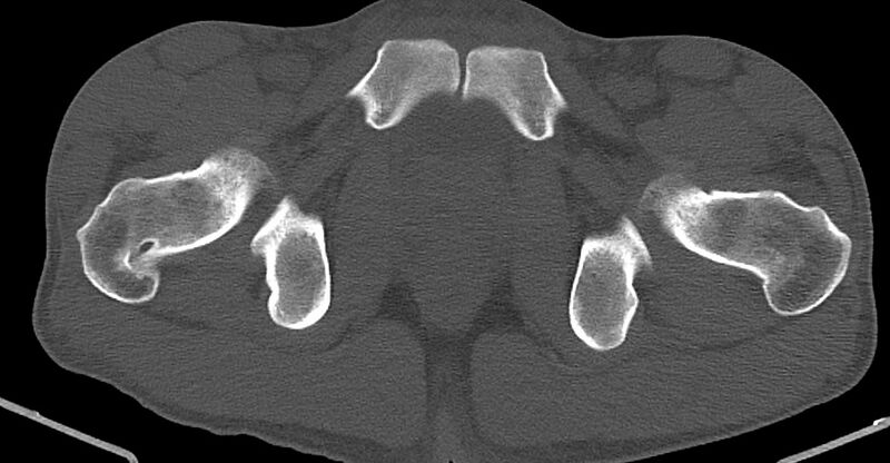 File:Chronic osteomyelitis (with sequestrum) (Radiopaedia 74813-85822 Axial non-contrast 44).jpg