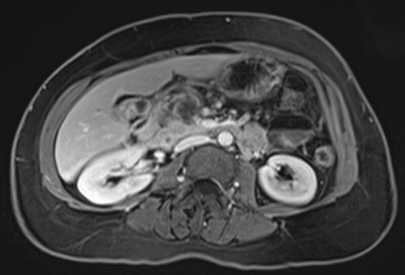 File:Chronic pancreatitis - pancreatic duct calculi (Radiopaedia 71818-82250 Axial T1 C+ fat sat 38).jpg