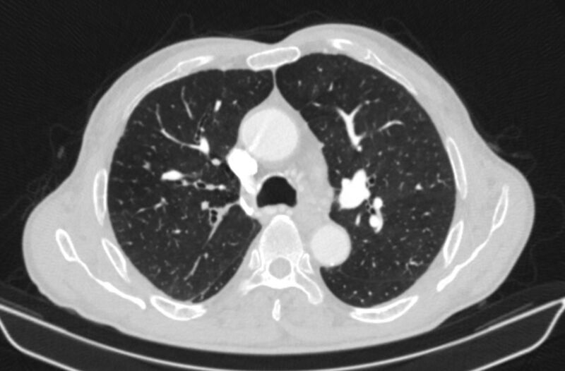File:Chronic pulmonary embolism (Radiopaedia 91241-108843 Axial lung window 32).jpg