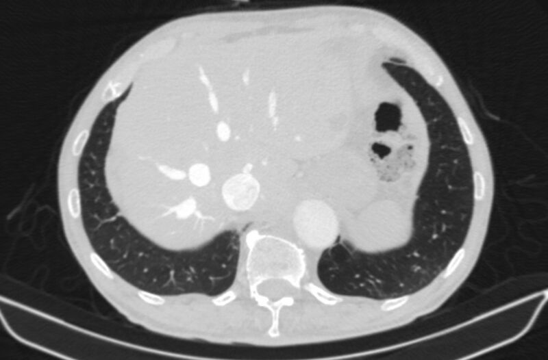 File:Chronic pulmonary embolism (Radiopaedia 91241-108843 Axial lung window 83).jpg