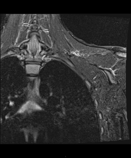 File:Chronic reactive multifocal osteomyelitis (CRMO) - clavicle (Radiopaedia 56406-63114 Coronal STIR 4).jpg