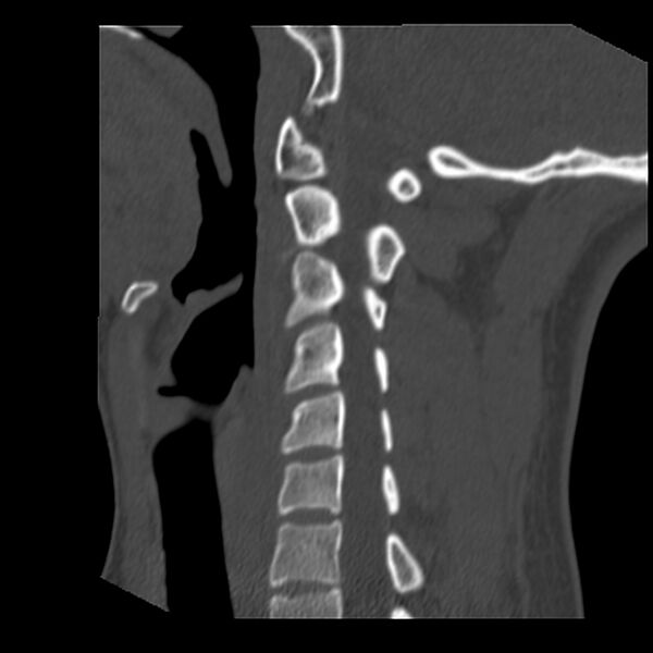 File:Clay-shoveler fracture (Radiopaedia 22568-22590 Sagittal bone window 28).jpg