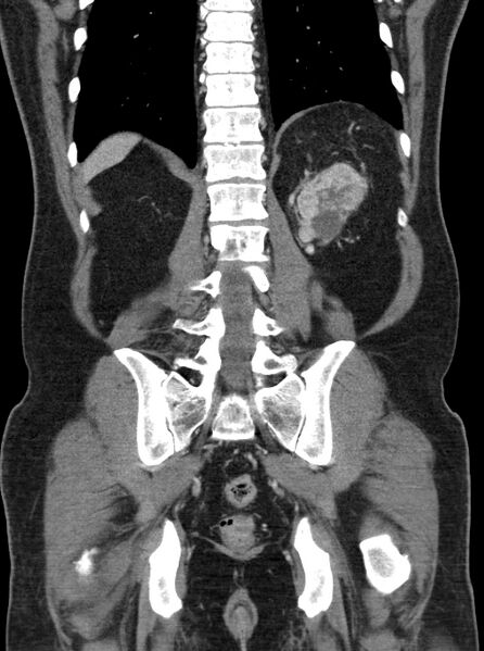 File:Clear cell renal cell carcinoma (Radiopaedia 61449-69393 F 43).jpg