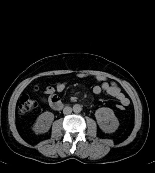 File:Clear cell renal cell carcinoma (Radiopaedia 85006-100539 Axial non-contrast 45).jpg