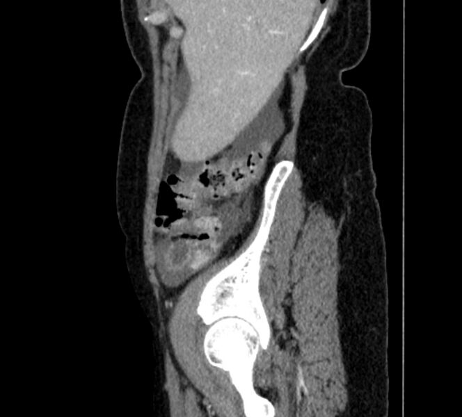 File:Closed loop small bowel obstruction (Radiopaedia 71211-81508 C 4).jpg