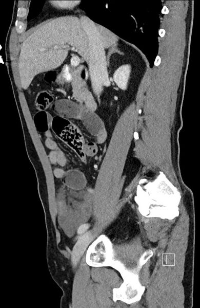 File:Closed loop small bowel obstruction - internal hernia (Radiopaedia 57806-64778 C 72).jpg
