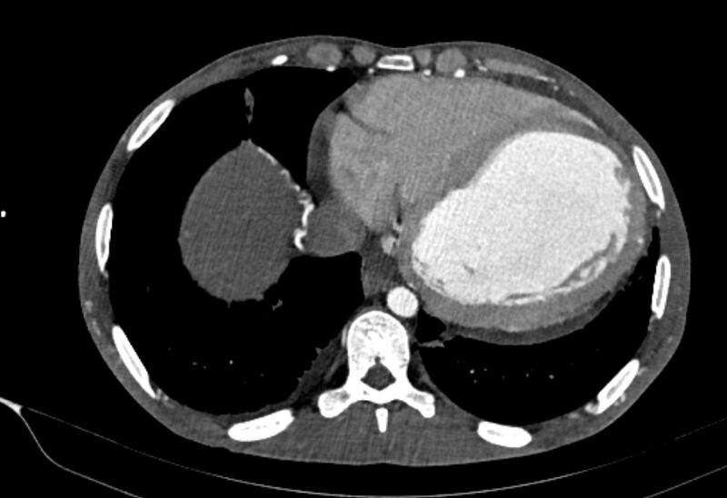 File:Coarctation of aorta with aortic valve stenosis (Radiopaedia 70463-80574 A 174).jpg