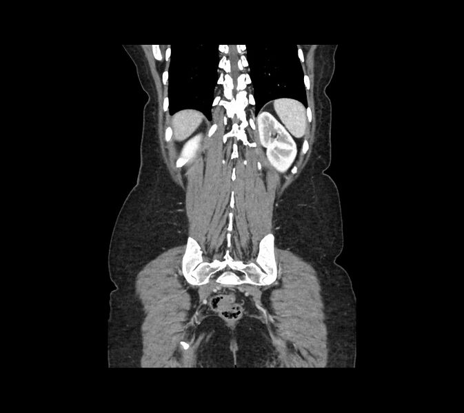 File:Cocoon abdomen with possible tubo-ovarian abscess (Radiopaedia 46235-50636 B 44).jpg