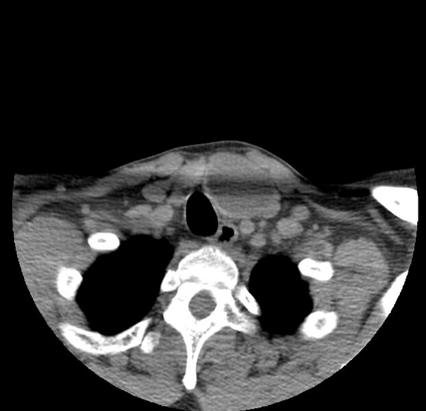 File:Colloid cyst of thyroid (Radiopaedia 22897-22923 Axial non-contrast 47).jpg