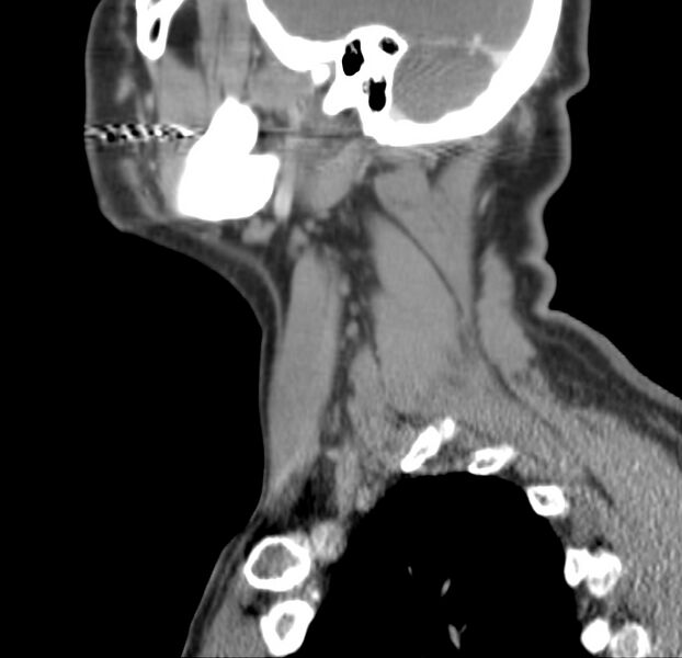 File:Colloid cyst of thyroid (Radiopaedia 22897-22923 Sagittal C+ delayed 16).jpg