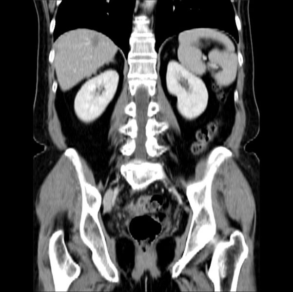 File:Colon carcinoma with hepatic metastases (Radiopaedia 29477-29961 B 30).jpg