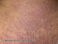 Lichen amyloidosis (DermNet NZ lichen-amyloidosis-12).jpg