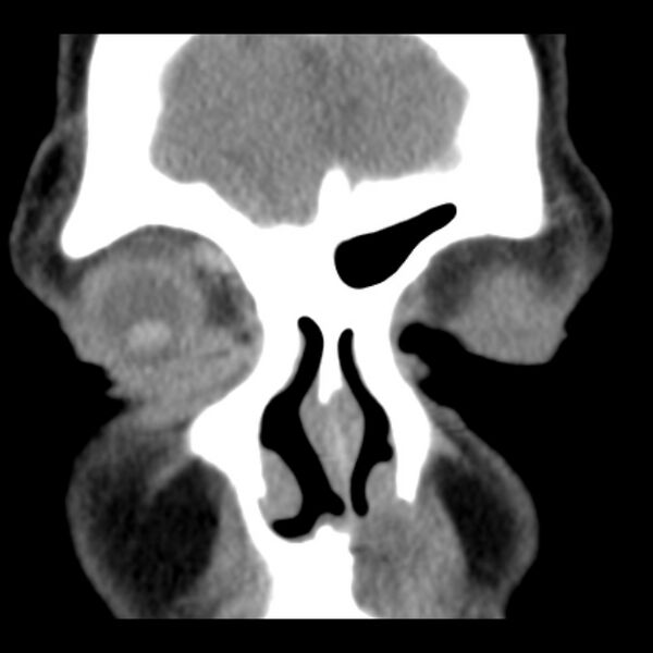 File:Nasolabial cyst (Radiopaedia 33987-35205 Coronal non-contrast 20).jpg