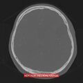 Nasopharyngeal carcinoma recurrence - skull base destruction (Radiopaedia 29107-29490 Axial bone window 46).jpg