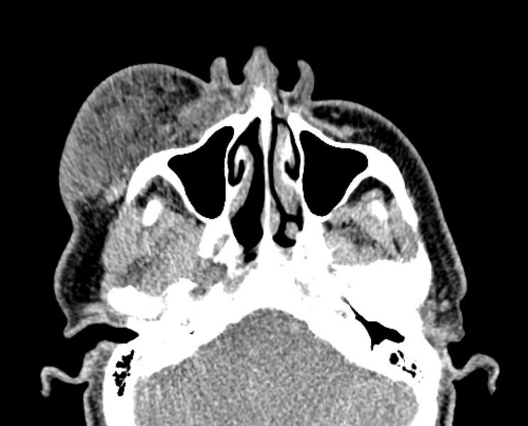 File:Necrobiotic xanthogranuloma- face (Radiopaedia 29549-30052 Axial C+ delayed 9).jpg