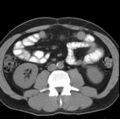 Necrotizing pancreatitis with acute necrotic collection (Radiopaedia 14470-14417 Axial non-contrast 28).jpg