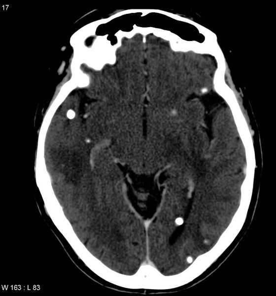 File:Neurocysticercosis (Radiopaedia 7773-8596 C+ delayed 5).jpg