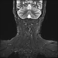 Neurofibromatosis type 1 (Radiopaedia 80355-93740 Coronal STIR 14).jpg