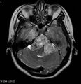 Neurofibromatosis type 2 - cranial and spinal involvement (Radiopaedia 5351-7111 Axial T2 6).jpg
