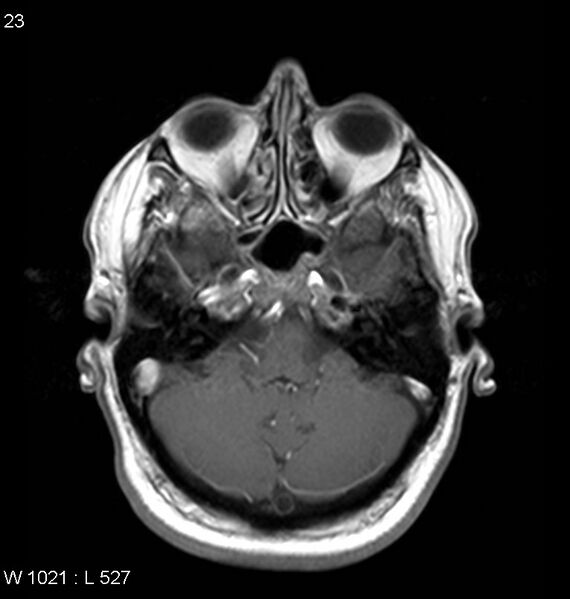 File:Neurosarcoidosis (Radiopaedia 10930-11351 Axial T1 C+ 4).jpg