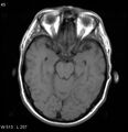 Neurosarcoidosis (Radiopaedia 10930-17204 Axial T1 7).jpg