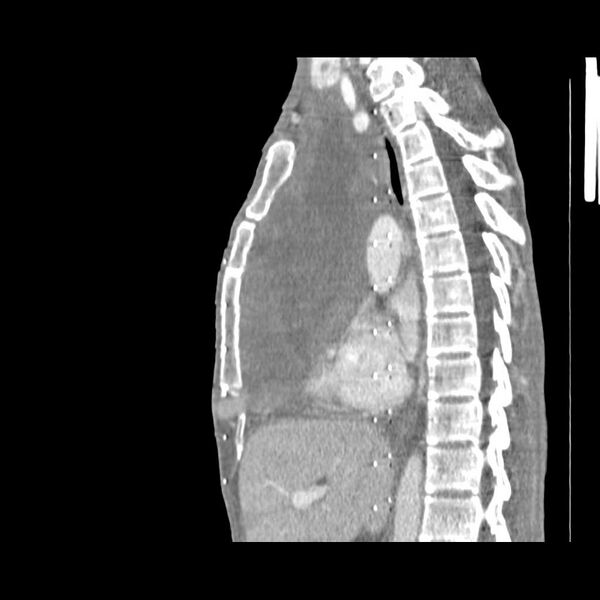 File:Non hodgkin lymphoma of the mediastinum (Radiopaedia 20814-20729 D 10).jpg