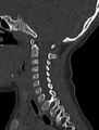Normal CT cervical spine - pediatric (Radiopaedia 52549-58462 Sagittal bone window 132).jpg
