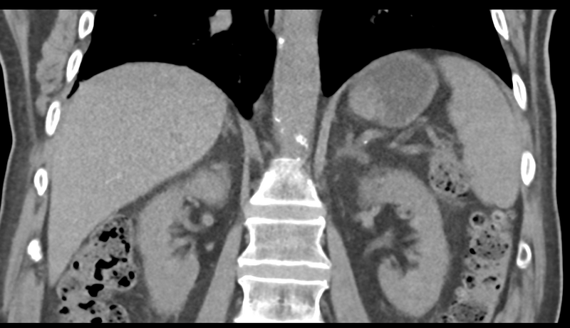 File:Normal CT intravenous cholangiogram (Radiopaedia 38199-40208 Coronal IVC 35).png