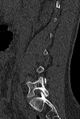 Normal CT lumbar spine (Radiopaedia 53981-60118 Sagittal bone window 24).jpg