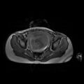 Normal MRI abdomen in pregnancy (Radiopaedia 88001-104541 Axial Gradient Echo 47).jpg