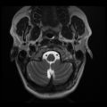 Normal cervical and thoracic spine MRI (Radiopaedia 35630-37156 Axial T2 33).png