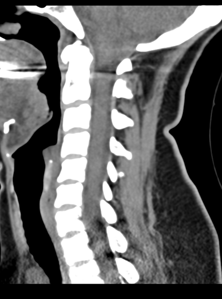 File:Normal cervical spine MRI (including Dixon) (Radiopaedia 42762-45926 C 30).png