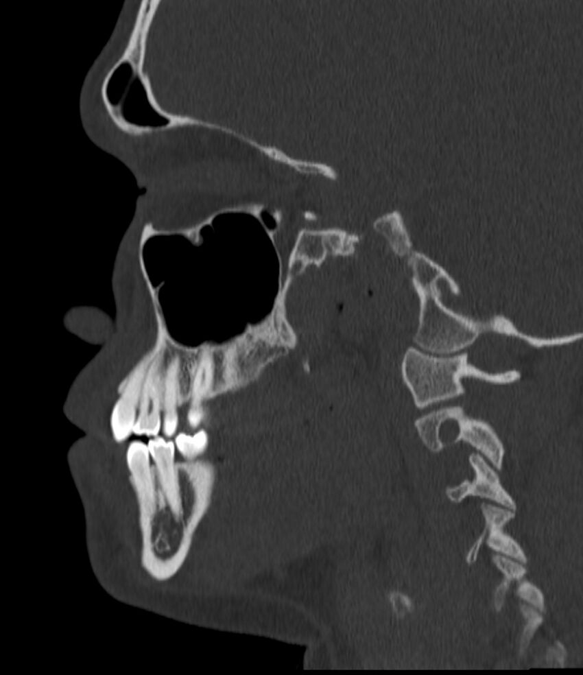 Normal facial bone CT (Radiopaedia 88742-105476 Sagittal bone window 69).jpg