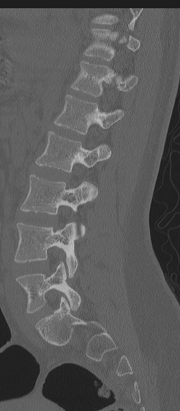 File:Normal lumbosacral CT (Radiopaedia 37923-39867 Sagittal bone window 38).png