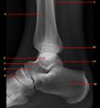 Normal radiographic anatomy of the ankle (Radiopaedia 42814-45987 B 1).jpg