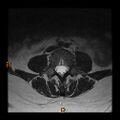 Normal spine MRI (Radiopaedia 77323-89408 Axial T2 11).jpg