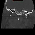 Occipital condyle fracture (Radiopaedia 18366-18208 Coronal bone window 2).jpg