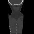 Occipital condyle fracture (Radiopaedia 31755-32691 Coronal bone window 41).jpg