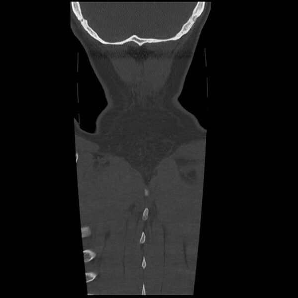 File:Occipital condyle fracture (Radiopaedia 31755-32691 Coronal bone window 41).jpg