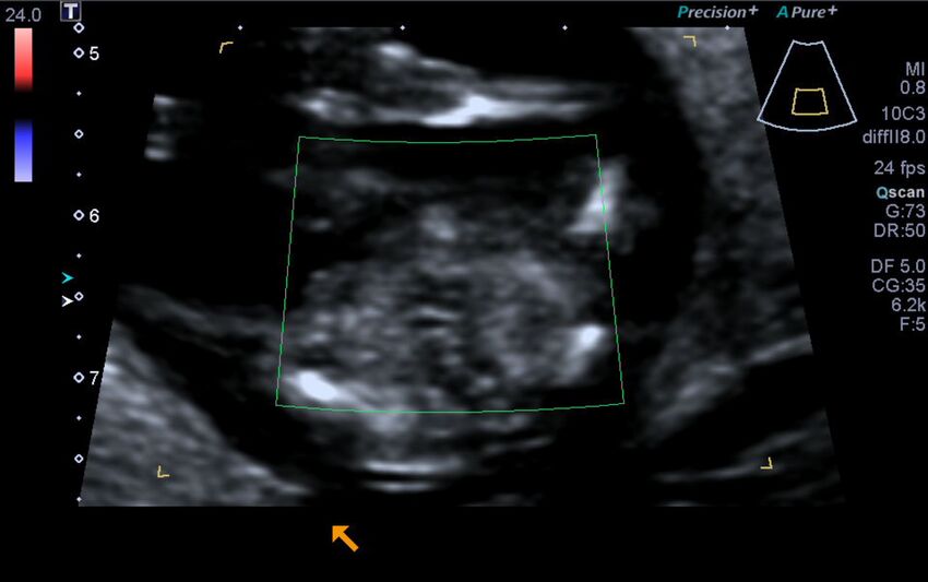 1st trimester nuchal-morphology ultrasound (Radiopaedia 44706-48477 Heart views cine with colour 206).jpg