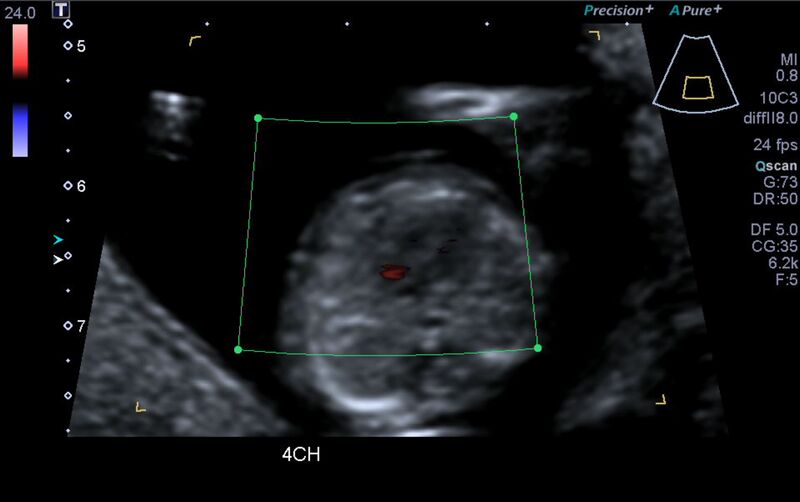 File:1st trimester nuchal-morphology ultrasound (Radiopaedia 44706-48477 Heart views cine with colour 33).jpg