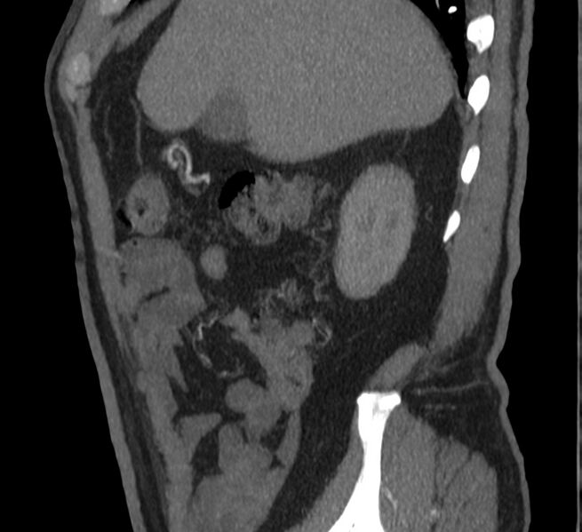 File:Abdominal aortic aneurysm (Radiopaedia 22421-22458 D 2).jpg