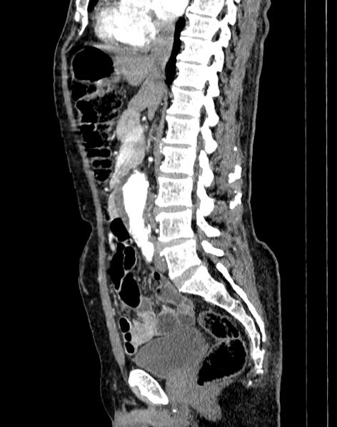 File:Abdominal aortic aneurysm (Radiopaedia 83581-98689 Sagittal C+ arterial phase 37).jpg