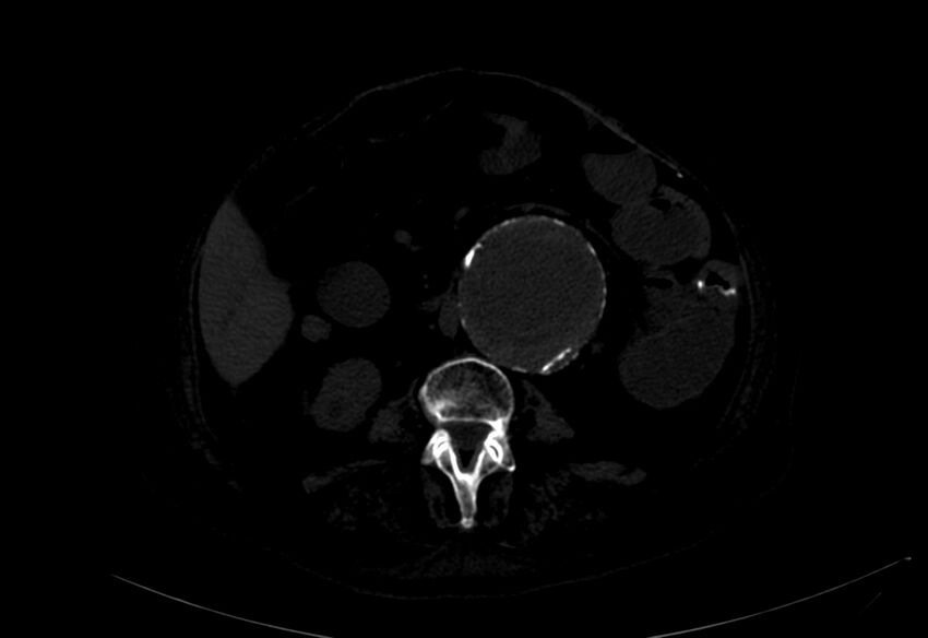 Abdominal aortic aneurysm - impending rupture (Radiopaedia 19233-19246 B 19).jpg