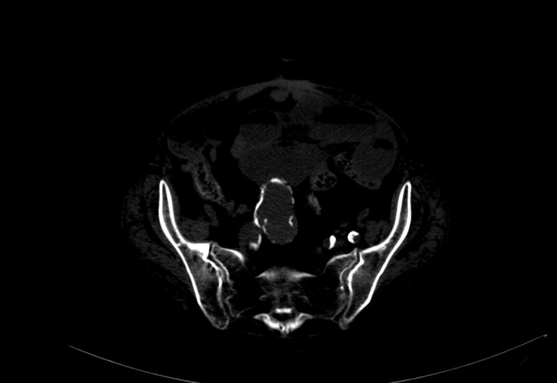File:Abdominal aortic aneurysm - impending rupture (Radiopaedia 19233-19246 B 46).jpg