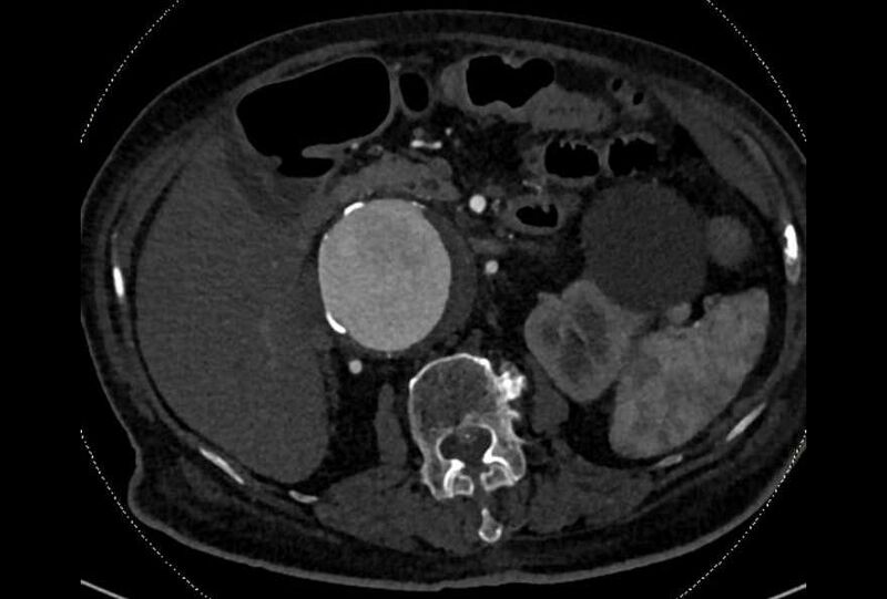 File:Abdominal aortic aneurysm with thrombus fissuration (Radiopaedia 73192-83919 Axial C+ arterial phase 55).jpg
