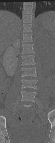 File:Abdominal multi-trauma - devascularised kidney and liver, spleen and pancreatic lacerations (Radiopaedia 34984-36486 Coronal bone window 24).png